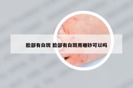 脸部有白斑 脸部有白斑用硼砂可以吗