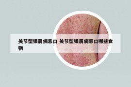关节型银屑病忌口 关节型银屑病忌口哪些食物