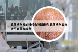银屑病刚发的时候会特别痒吗 银屑病刚出来会不会是大红点