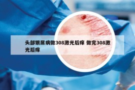 头部银屑病做308激光后痒 做完308激光后痒