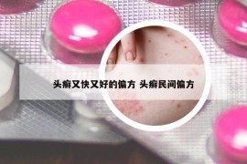 头癣又快又好的偏方 头癣民间偏方