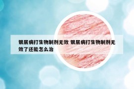 银屑病打生物制剂无效 银屑病打生物制剂无效了还能怎么治