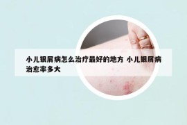 小儿银屑病怎么治疗最好的地方 小儿银屑病治愈率多大