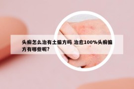 头癣怎么治有土偏方吗 治愈100%头癣偏方有哪些呢?