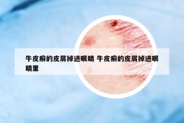 牛皮癣的皮屑掉进眼睛 牛皮癣的皮屑掉进眼睛里