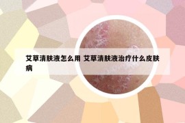 艾草清肤液怎么用 艾草清肤液治疗什么皮肤病