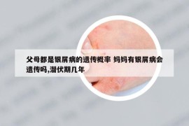 父母都是银屑病的遗传概率 妈妈有银屑病会遗传吗,潜伏期几年
