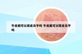 牛皮癣可以用皮炎平吗 牛皮廨可以擦皮炎平吗