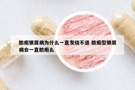 脓疱银屑病为什么一直发烧不退 脓疱型银屑病会一直脓疱么