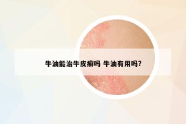 牛油能治牛皮癣吗 牛油有用吗?
