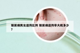 银屑病男女遗传比例 银屑病遗传率大概多少?