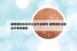 雄黄蜈蚣白及可以治牛皮癣吗 雄黄蜈蚣白矾治疗带状疱疹