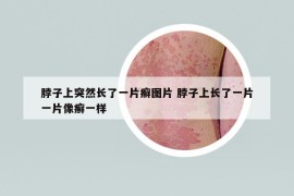 脖子上突然长了一片癣图片 脖子上长了一片一片像癣一样