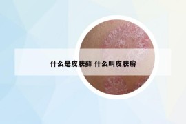 什么是皮肤藓 什么叫皮肤癣
