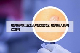 银屑病喝红酒怎么喝比较安全 银屑病人能喝红酒吗