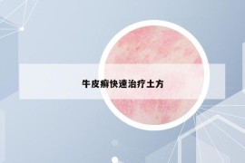 牛皮癣快速治疗土方
