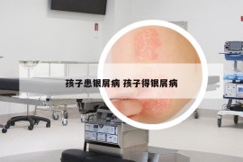孩子患银屑病 孩子得银屑病