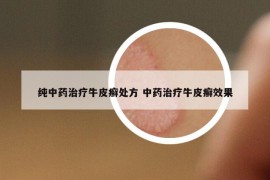 纯中药治疗牛皮癣处方 中药治疗牛皮癣效果