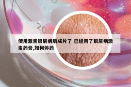 使用激素银屑病后成片了 已经用了银屑病激素药膏,如何停药