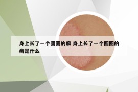 身上长了一个圆圈的癣 身上长了一个圆圈的癣是什么