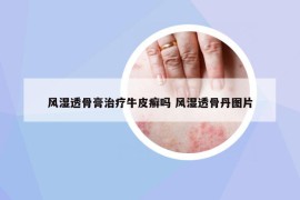 风湿透骨膏治疗牛皮癣吗 风湿透骨丹图片