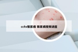 cctv银屑病 银屑病视频讲座