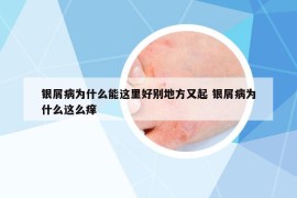 银屑病为什么能这里好别地方又起 银屑病为什么这么痒