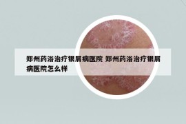 郑州药浴治疗银屑病医院 郑州药浴治疗银屑病医院怎么样