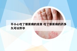 不小心吃了银屑病的皮屑 吃了银屑病的药多久可以怀孕