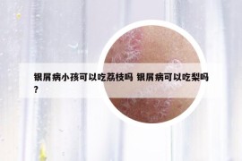 银屑病小孩可以吃荔枝吗 银屑病可以吃梨吗?