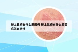 脚上起癣有什么原因吗 脚上起癣有什么原因吗怎么治疗