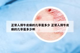 正常人得牛皮癣的几率是多少 正常人得牛皮癣的几率是多少啊