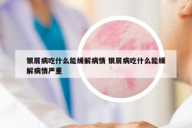 银屑病吃什么能缓解病情 银屑病吃什么能缓解病情严重