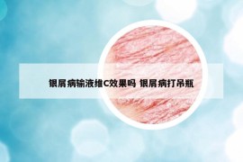 银屑病输液维C效果吗 银屑病打吊瓶