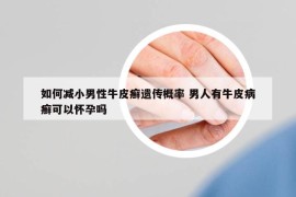 如何减小男性牛皮癣遗传概率 男人有牛皮病癣可以怀孕吗