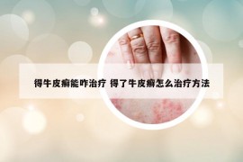 得牛皮癣能咋治疗 得了牛皮癣怎么治疗方法