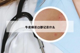牛皮癣忌口都记忌什么