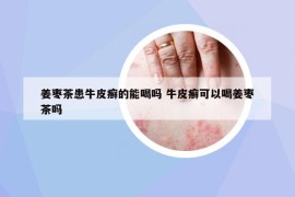 姜枣茶患牛皮癣的能喝吗 牛皮癣可以喝姜枣茶吗