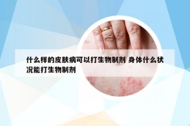 什么样的皮肤病可以打生物制剂 身体什么状况能打生物制剂