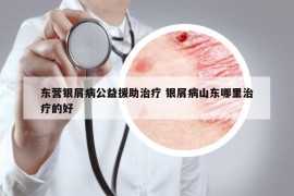 东营银屑病公益援助治疗 银屑病山东哪里治疗的好