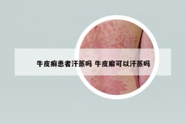 牛皮癣患者汗蒸吗 牛皮廨可以汗蒸吗