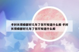 手肘长得癣都好几年了但不知道什么癣 手肘长得癣都好几年了但不知道什么癣