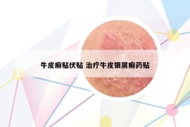 牛皮癣贴伏贴 治疗牛皮银屑癣药贴