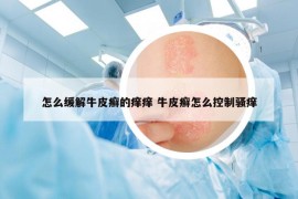 怎么缓解牛皮癣的痒痒 牛皮癣怎么控制骚痒