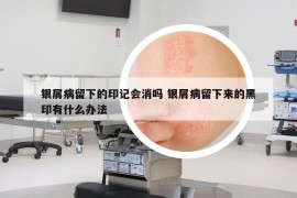 银屑病留下的印记会消吗 银屑病留下来的黑印有什么办法