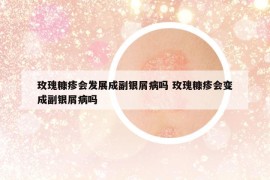 玫瑰糠疹会发展成副银屑病吗 玫瑰糠疹会变成副银屑病吗