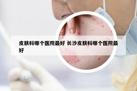 皮肤科哪个医院最好 长沙皮肤科哪个医院最好