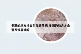 多潮的地方才会引发银屑病 多潮的地方才会引发银屑病吗