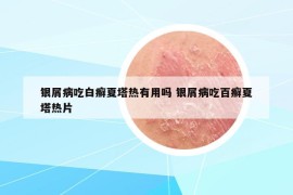 银屑病吃白癣夏塔热有用吗 银屑病吃百癣夏塔热片