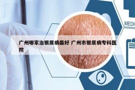 广州哪家治银屑病最好 广州市银屑病专科医院